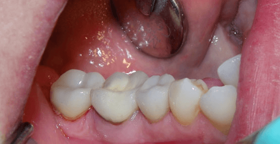 Crowns and Onlays After