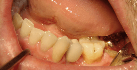 Implant After