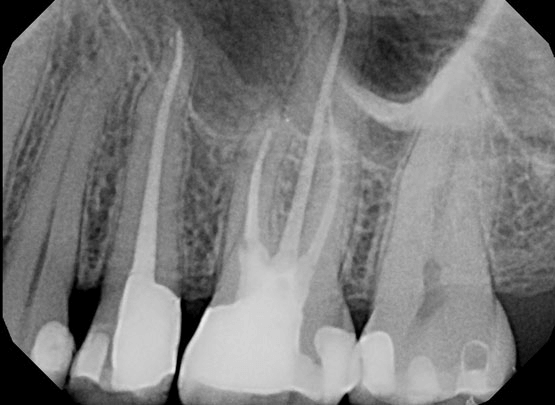 Root Canal - After