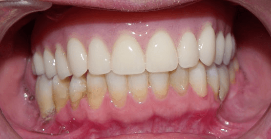 Smile Reconstruction After