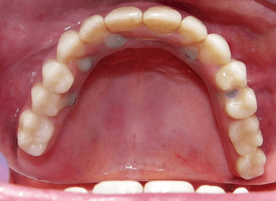 Smile Reconstruction After