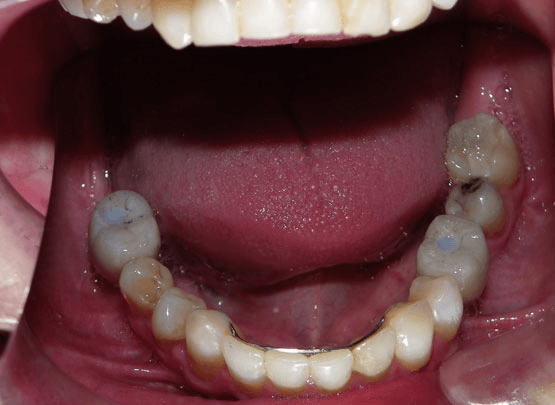 Smile Reconstruction After