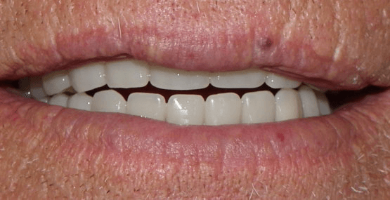 Smile Reconstruction After