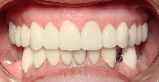 Smile Reconstruction After