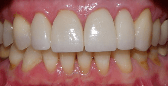 Smile Reconstruction After