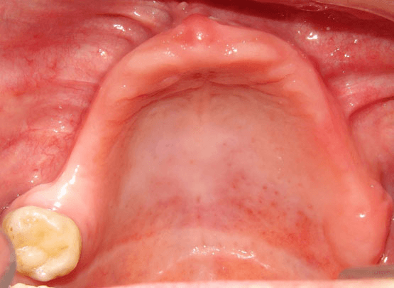 Smile Reconstruction Before