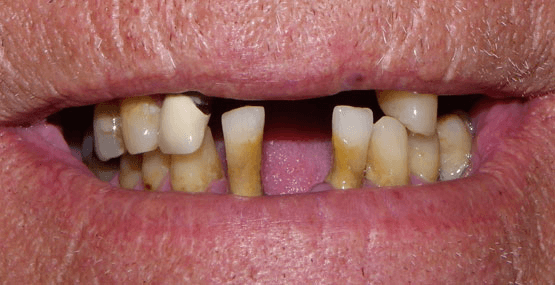 Smile Reconstruction Before