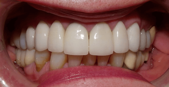 Veneers After