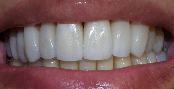 Veneers After