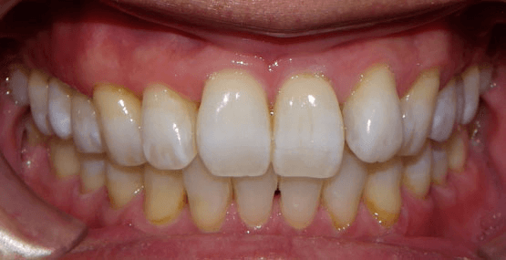 Whitening After