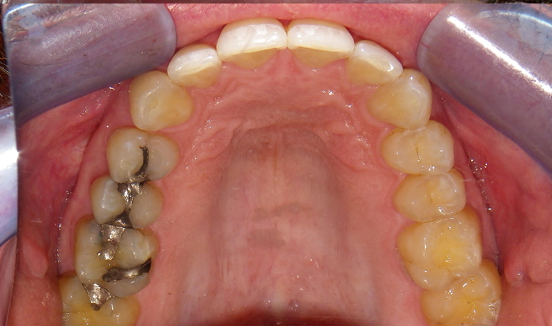 Upper palate with natural tooth spacing