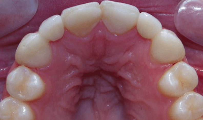 Upper dental arch showing palate