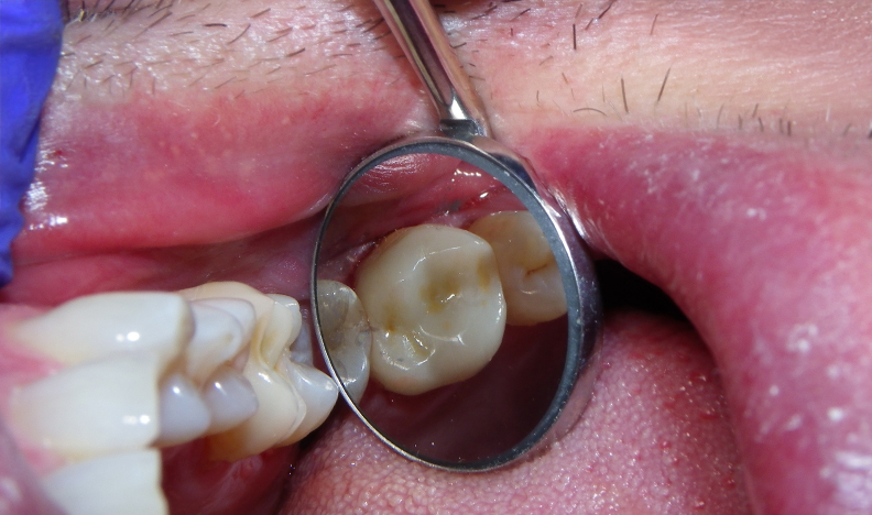 Dental mirror examining molar tooth