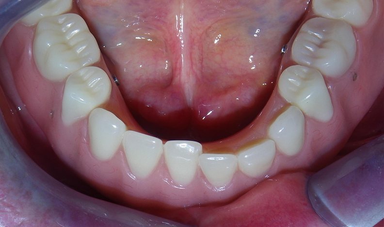 Intraoral view showing implant posts
