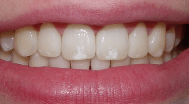 Dental procedure using mirror and tools