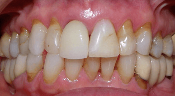 Smile showing aligned upper teeth