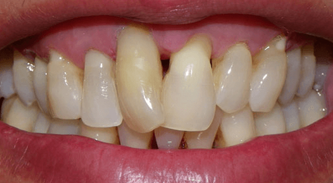Close-up of front teeth and gums