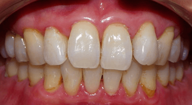 Smile showing cosmetic dental improvement