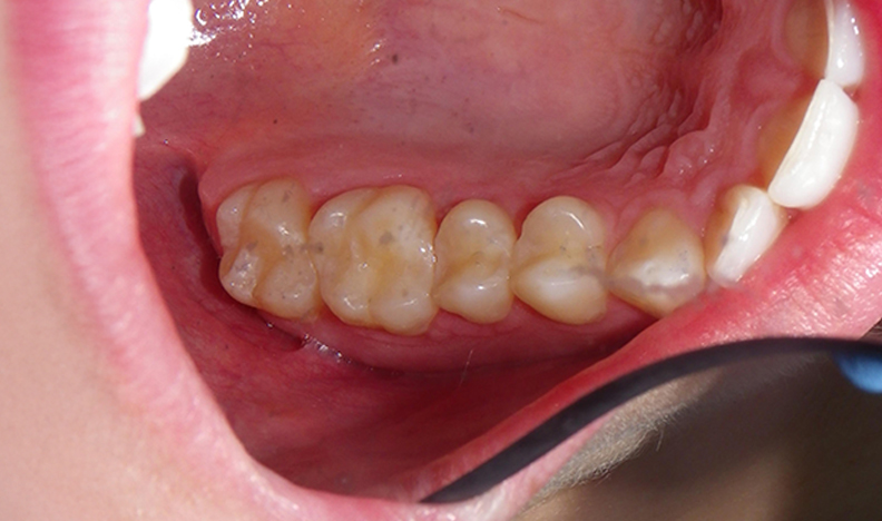 Intraoral image showing molars and gums
