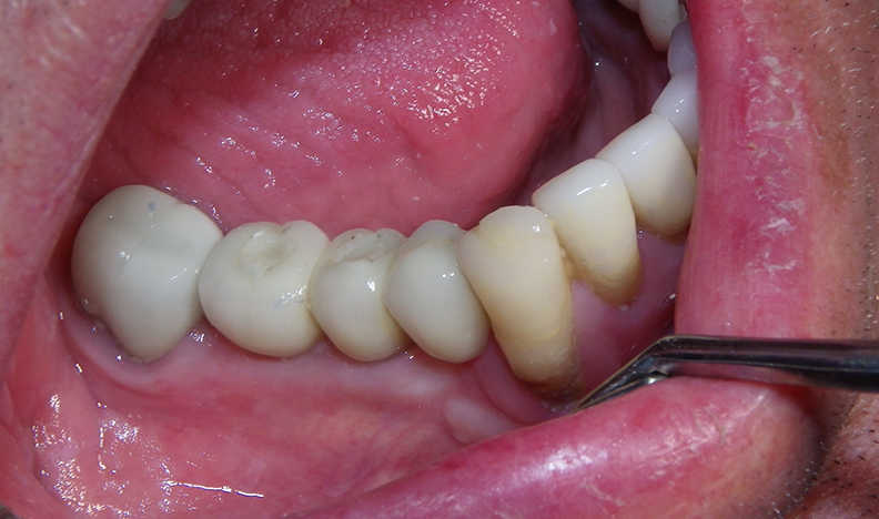 Intraoral view with dental implants visible