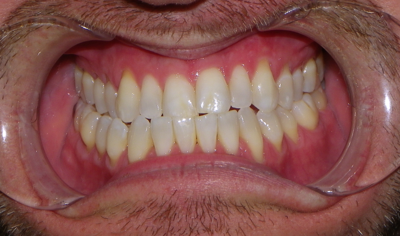 Smile showing even tooth alignment