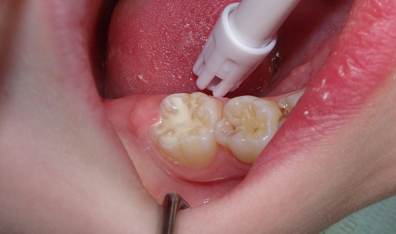 Tooth surface during restorative dental procedure