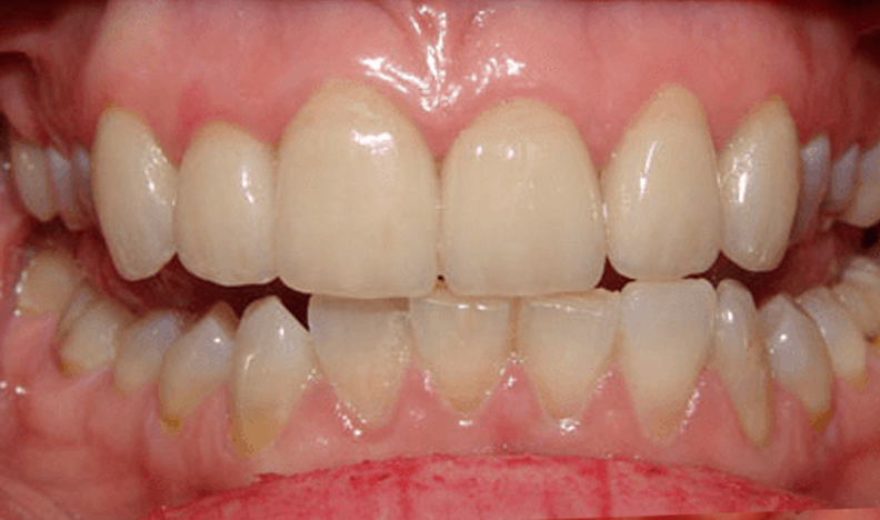 Close-up of teeth showing natural alignment