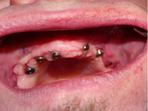 Six dental implants placed in the upper jaw before restoration.