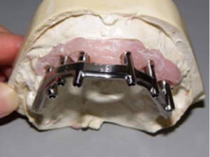 Computer-milled titanium framework for an implant-supported denture.
