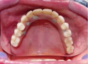 Completed fixed implant-supported upper denture in the mouth.