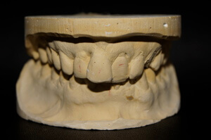 Impression of pre-op dentition