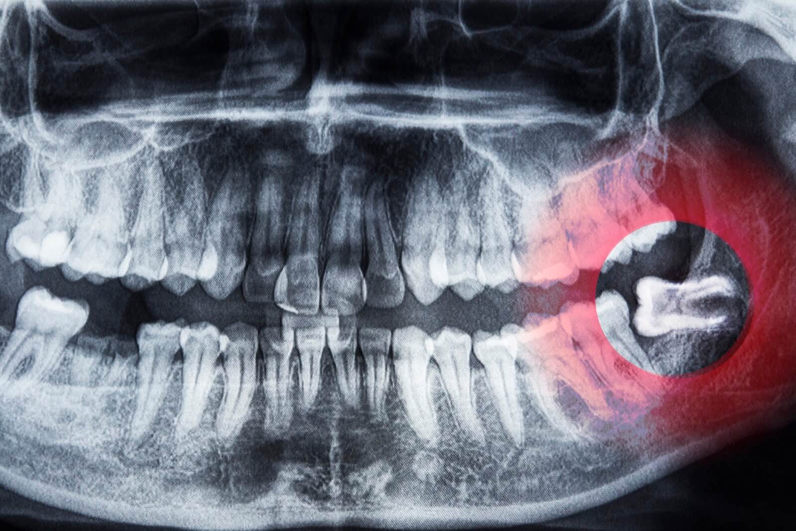 an xray of teeth