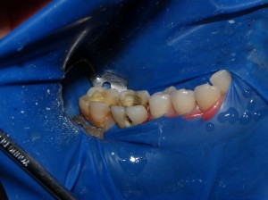Intraoral view with rubber dam on