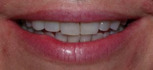 X07906 Postop for discoloured 12 resin veneer