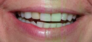 Discoloured tooth 12 preop