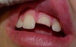 21 Horizontal enamel-dentin fracture