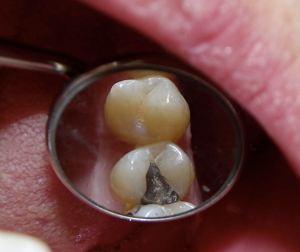 cavity side of molar