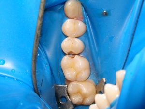 Early interproximal caries