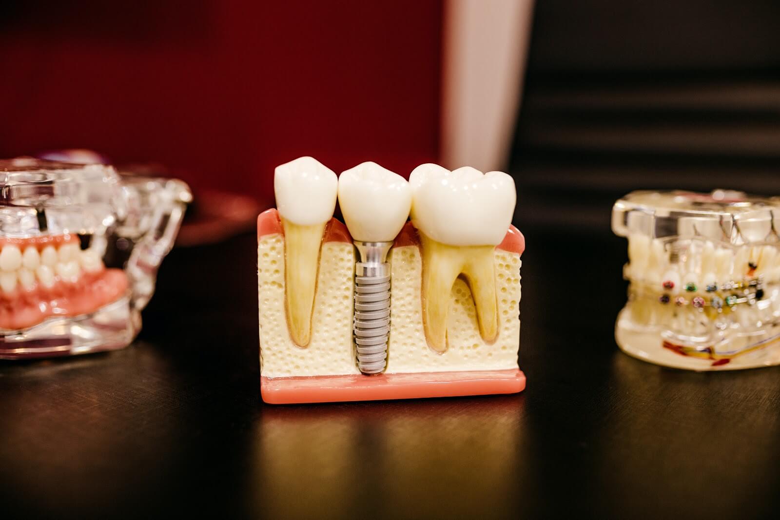 an image of a moulding of three teeth, two are growing into the moulding appearing to show natural teeth, versus one that has a screw driver at the end of it